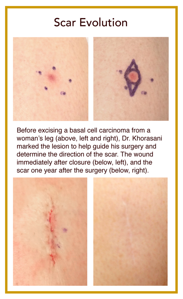 skin scar removal surgery