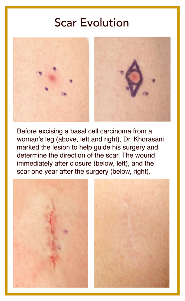 Scar Removal By Dermatologist at Albert Jenkins blog